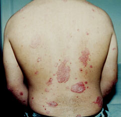 Immagini dermatite da contatto